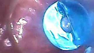 Endoscope POV: Test Tube Cock Urethral Insertion