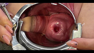 Two Toothbrushes in Cervix